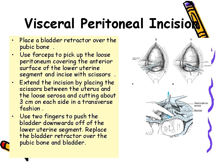 Visceral Peritoneal Incision • Place a bladder retractor over the pubic bone . •