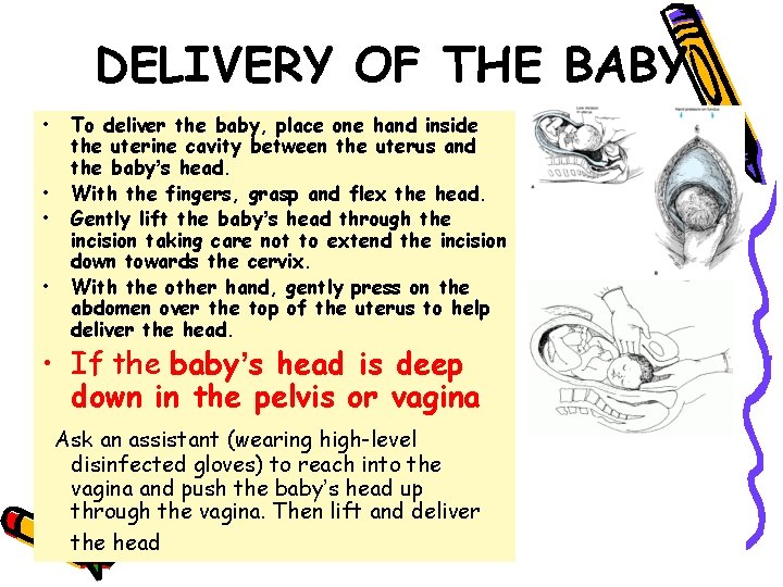 DELIVERY OF THE BABY • • To deliver the baby, place one hand inside