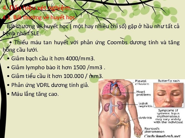 4. Dấu hiệu xét nghiệm. 4. 1. Bất thường về huyết học ( một