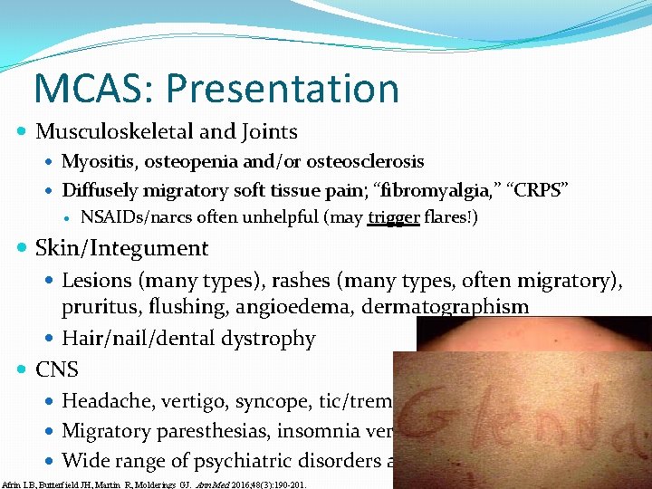 MCAS: Presentation Musculoskeletal and Joints Myositis, osteopenia and/or osteosclerosis Diffusely migratory soft tissue pain;