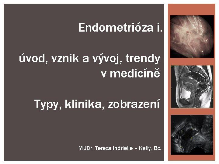 Endometrióza i. úvod, vznik a vývoj, trendy v medicíně Typy, klinika, zobrazení MUDr. Tereza