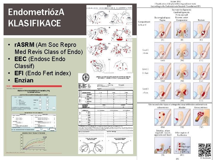 Endometrióz. A KLASIFIKACE • r. ASRM (Am Soc Repro Med Revis Class of Endo)