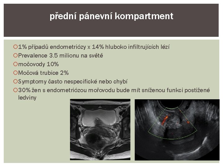 přední pánevní kompartment 1% případů endometriózy x 14% hluboko infiltrujících lézí Prevalence 3. 5