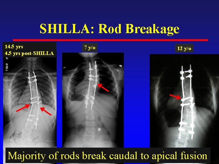 SHILLA: Rod Breakage 14. 5 yrs post-SHILLA 7 y/o 12 y/o Majority of rods