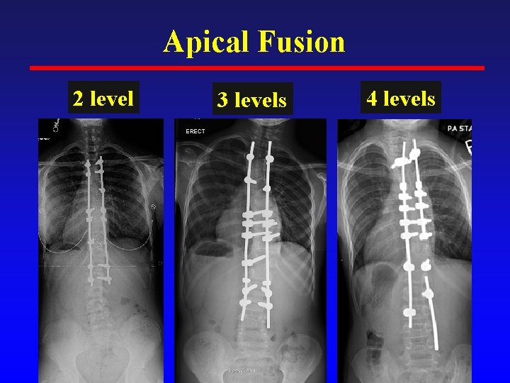 Apical Fusion 2 level 3 levels 4 levels 