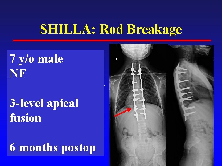 SHILLA: Rod Breakage • 12 y/o female 7 y/o male • Sz disorder NF