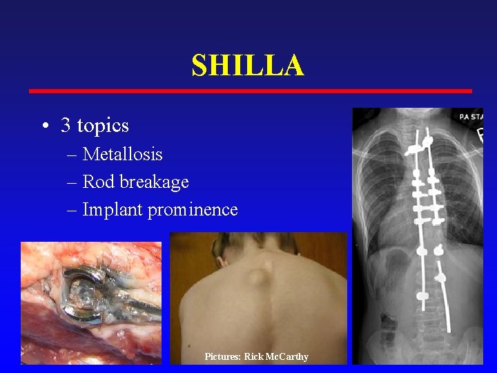 SHILLA • 3 topics – Metallosis – Rod breakage – Implant prominence Pictures: Rick