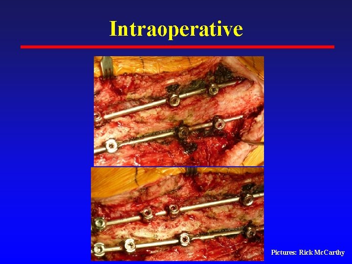 Intraoperative Pictures: Rick Mc. Carthy 