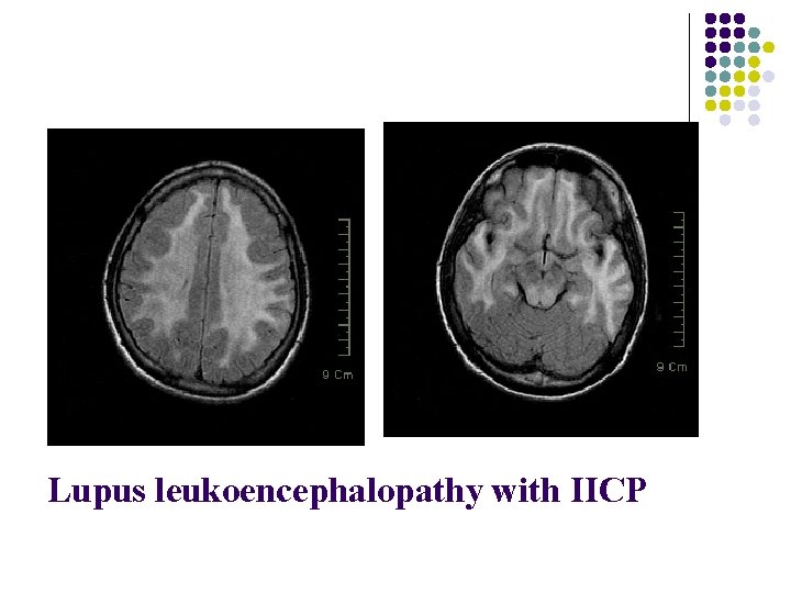 Lupus leukoencephalopathy with IICP 