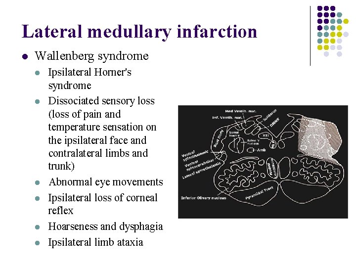Lateral medullary infarction l Wallenberg syndrome l l l Ipsilateral Horner's syndrome Dissociated sensory