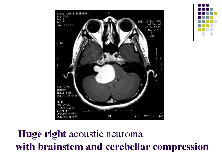  Huge right acoustic neuroma with brainstem and cerebellar compression 