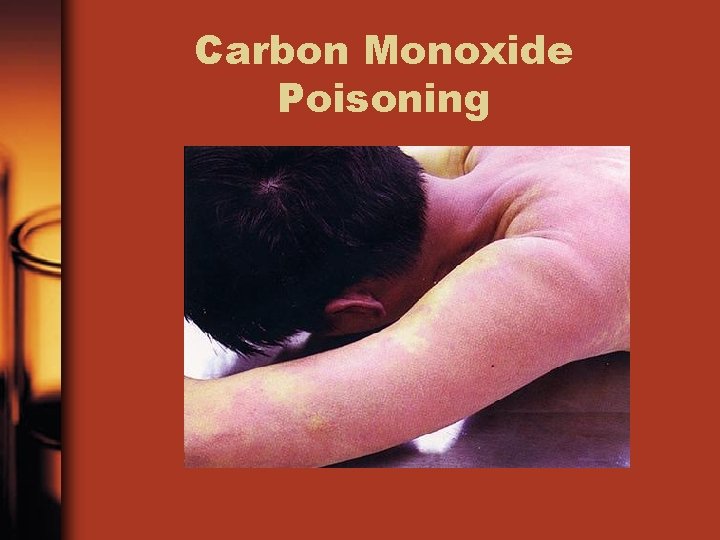 Carbon Monoxide Poisoning 