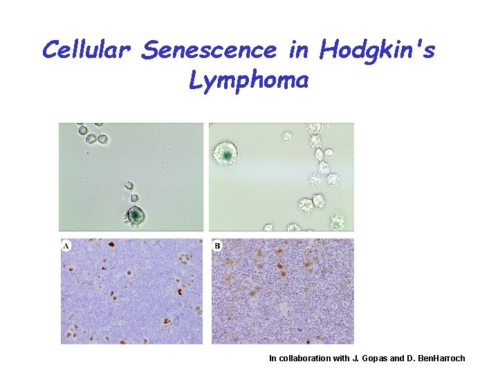 Cellular Senescence in Hodgkin's Lymphoma In collaboration with J. Gopas and D. Ben. Harroch