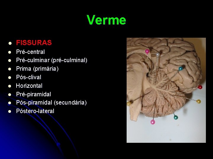 Verme l FISSURAS l Pré-central Pré-culminar (pré-culminal) Prima (primária) Pós-clival Horizontal Pré-piramidal Pós-piramidal (secundária)