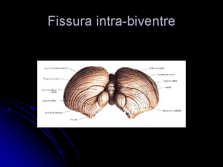 Fissura intra-biventre 