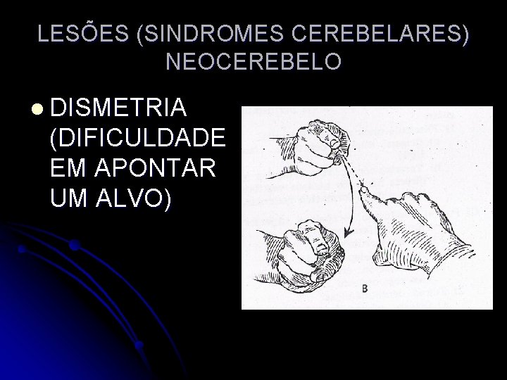 LESÕES (SINDROMES CEREBELARES) NEOCEREBELO l DISMETRIA (DIFICULDADE EM APONTAR UM ALVO) 