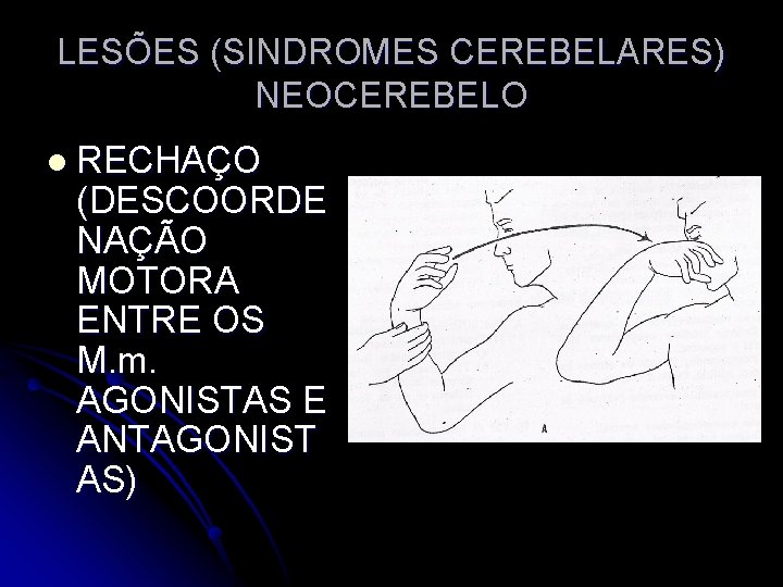 LESÕES (SINDROMES CEREBELARES) NEOCEREBELO l RECHAÇO (DESCOORDE NAÇÃO MOTORA ENTRE OS M. m. AGONISTAS