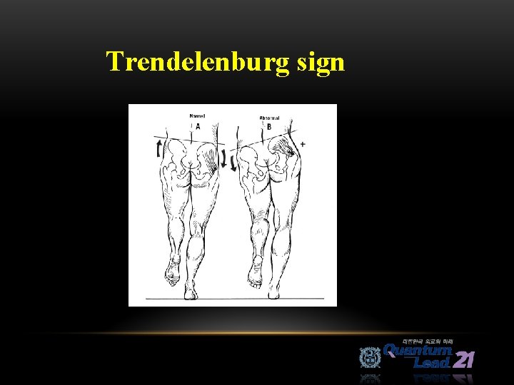 Trendelenburg sign 