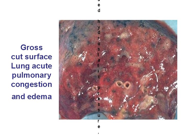 Gross cut surface Lung acute pulmonary congestion and edema s e d h y