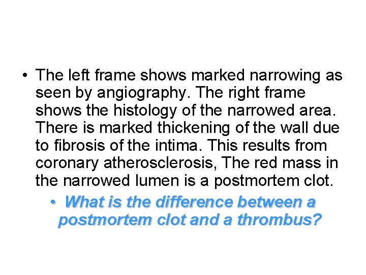  • The left frame shows marked narrowing as seen by angiography. The right