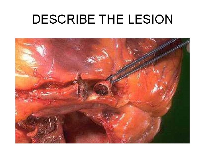 DESCRIBE THE LESION 