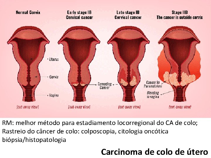 RM: melhor método para estadiamento locorregional do CA de colo; Rastreio do câncer de