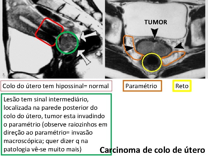 TUMOR Colo do útero tem hipossinal= normal Paramétrio Reto Lesão tem sinal intermediário, localizada