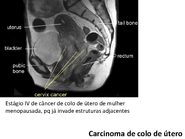 Estágio IV de câncer de colo de útero de mulher menopausada, pq já invade