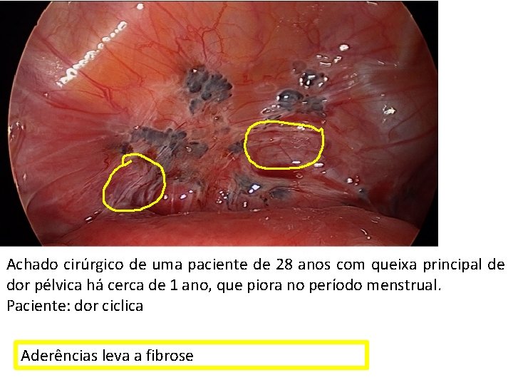 Achado cirúrgico de uma paciente de 28 anos com queixa principal de dor pélvica