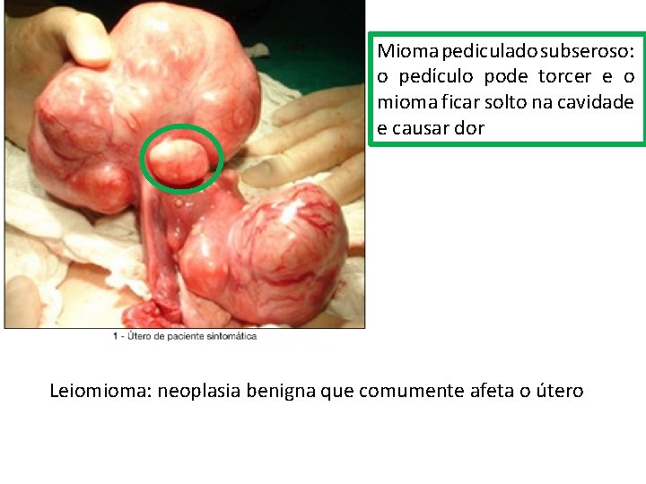 Mioma pediculado subseroso: o pedículo pode torcer e o mioma ficar solto na cavidade