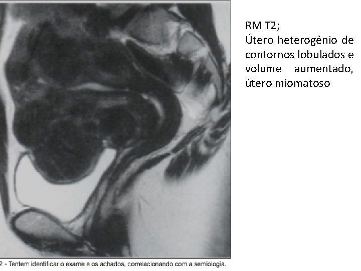 RM T 2; Útero heterogênio de contornos lobulados e volume aumentado, útero miomatoso 