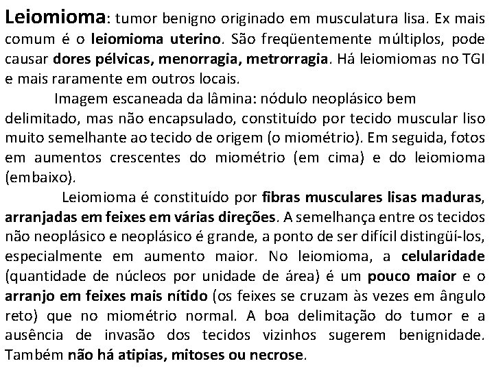 Leiomioma: tumor benigno originado em musculatura lisa. Ex mais comum é o leiomioma uterino.