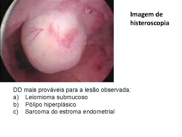 Imagem de histeroscopia DD mais prováveis para a lesão observada: a) Leiomioma submucoso b)