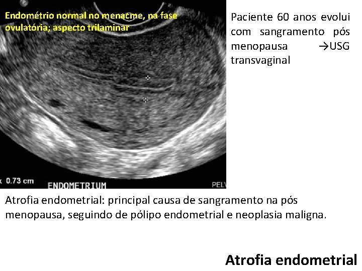 Endométrio normal no menacme, na fase ovulatória; aspecto trilaminar Paciente 60 anos evolui com
