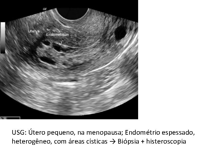 USG: Útero pequeno, na menopausa; Endométrio espessado, heterogêneo, com áreas císticas → Biópsia +