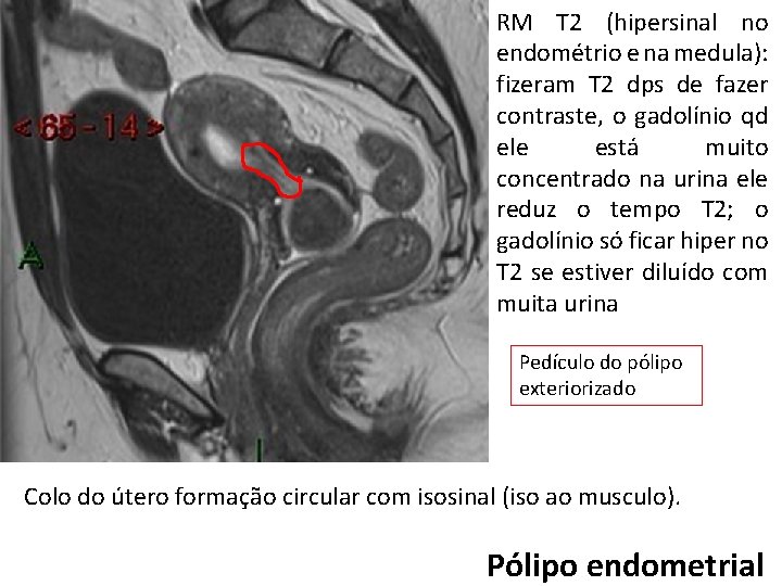 RM T 2 (hipersinal no endométrio e na medula): fizeram T 2 dps de