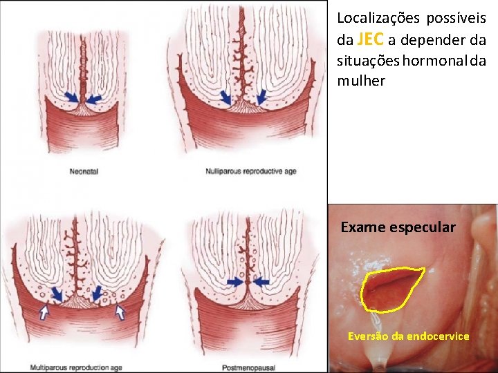 Localizações possíveis da JEC a depender da situações hormonal da mulher Exame especular Eversão