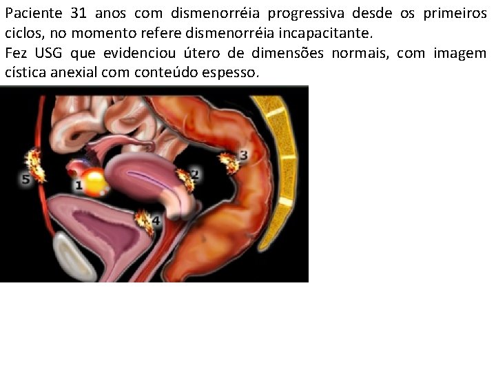 Paciente 31 anos com dismenorréia progressiva desde os primeiros ciclos, no momento refere dismenorréia