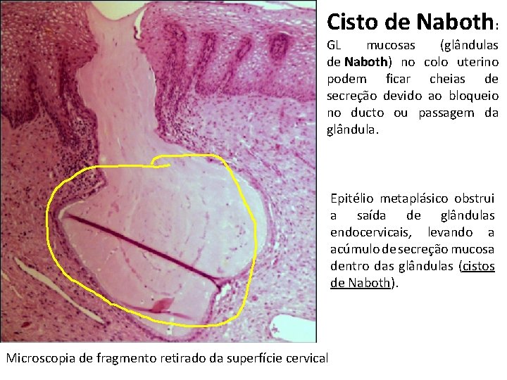 Cisto de Naboth: GL mucosas (glândulas de Naboth) no colo uterino podem ficar cheias