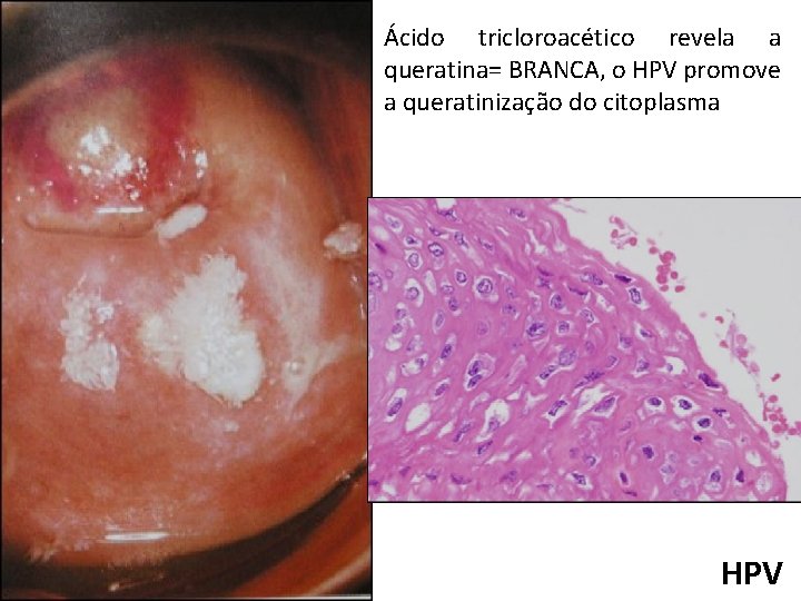 Ácido tricloroacético revela a queratina= BRANCA, o HPV promove a queratinização do citoplasma HPV