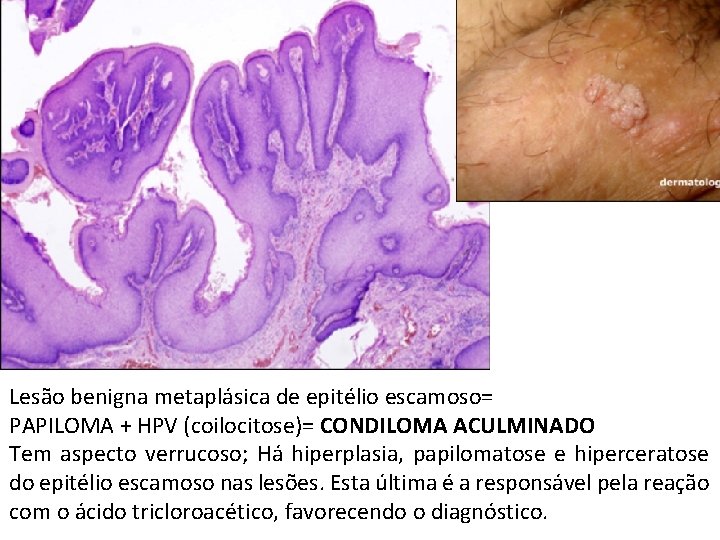Lesão benigna metaplásica de epitélio escamoso= PAPILOMA + HPV (coilocitose)= CONDILOMA ACULMINADO Tem aspecto