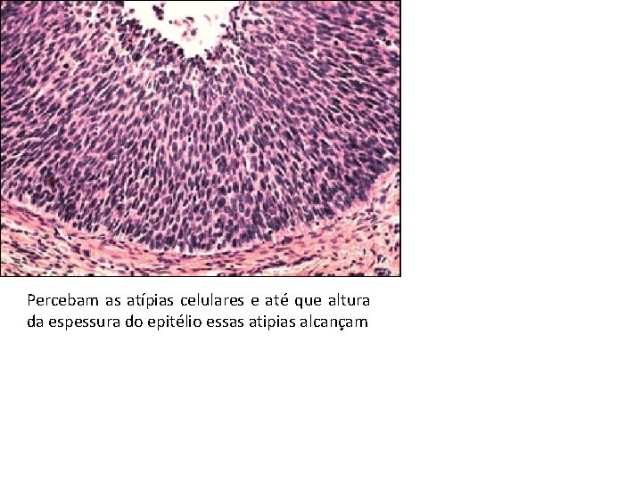 Percebam as atípias celulares e até que altura da espessura do epitélio essas atipias