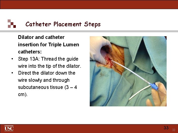 Catheter Placement Steps Dilator and catheter insertion for Triple Lumen catheters: • Step 13