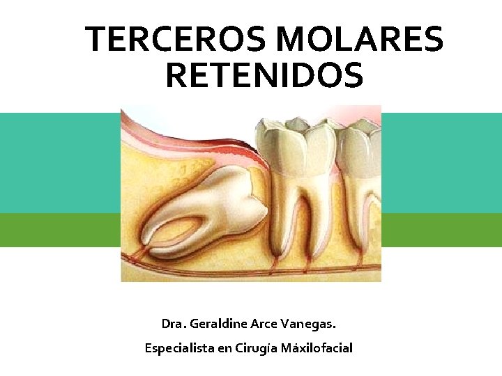 TERCEROS MOLARES RETENIDOS Dra. Geraldine Arce Vanegas. Especialista en Cirugía Máxilofacial 
