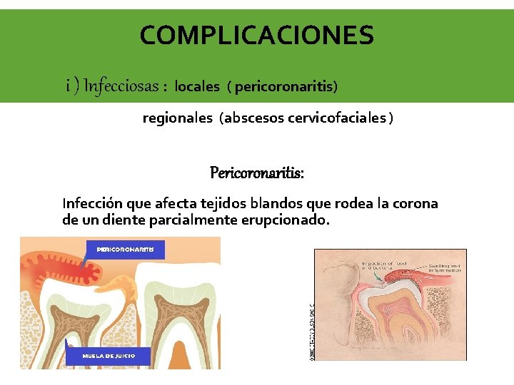 COMPLICACIONES i ) Infecciosas : locales ( pericoronaritis) regionales (abscesos cervicofaciales ) Pericoronaritis: Infección