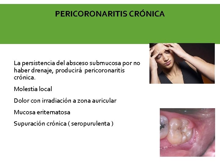PERICORONARITIS CRÓNICA La persistencia del absceso submucosa por no haber drenaje, producirá pericoronaritis crónica.