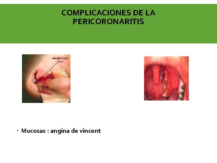 COMPLICACIONES DE LA PERICORONARITIS Mucosas : angina de vincent 