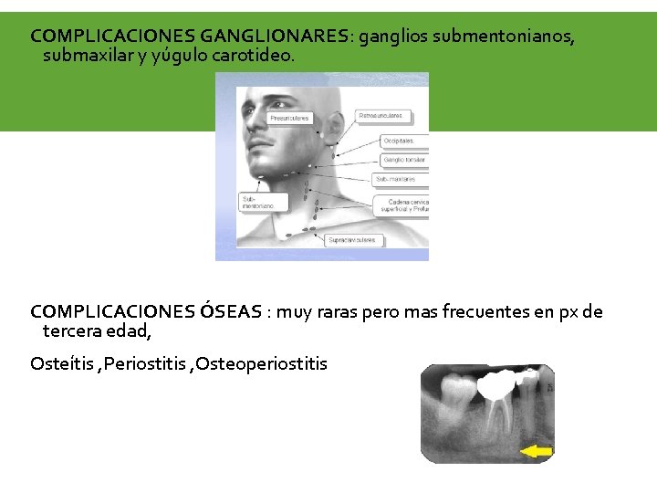 COMPLICACIONES GANGLIONARES: ganglios submentonianos, submaxilar y yúgulo carotideo. COMPLICACIONES ÓSEAS : muy raras pero