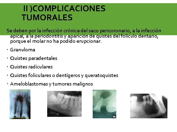 II )COMPLICACIONES TUMORALES Se deben por la infección crónica del saco pericoronario, a la