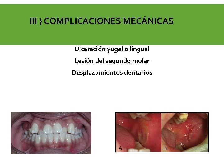 III ) COMPLICACIONES MECÁNICAS Ulceración yugal o lingual Lesión del segundo molar Desplazamientos dentarios